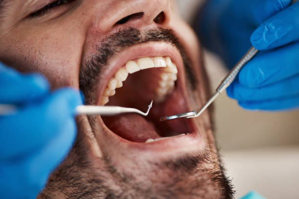 Best Knocked-Out Tooth (Avulsed Tooth) Treatment in Cottonwood Shores, TX